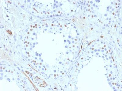 Formalin-fixed, paraffin embedded human testis sections stained with 100 ul anti-Wilms Tumor 1 (clone 6F-H2) at 1:400. HIER epitope retrieval prior to staining was performed in 10mM Citrate, pH 6.0.